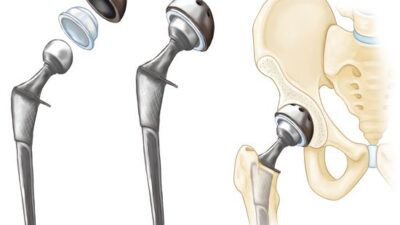 When to Consider Hip Replacement